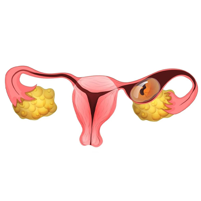 Ectopic Pregnancy