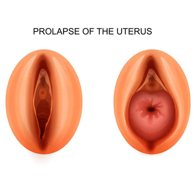 Uterine Prolapse