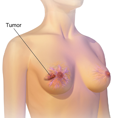 Breast Diseases