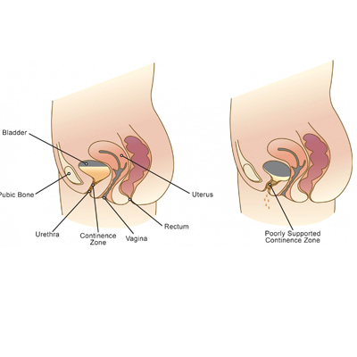 Stress Urinary Incontinence