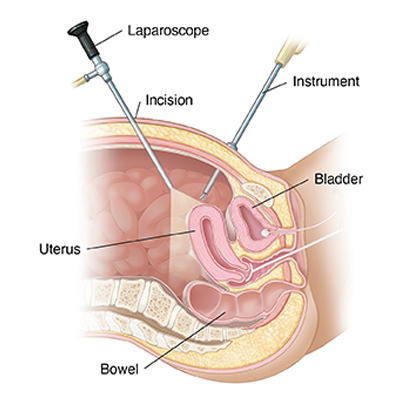 Laparoscopic Hysterectomy