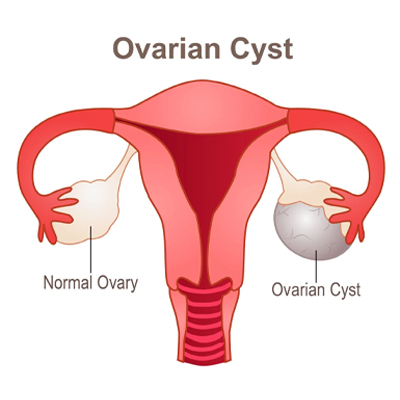 Ovarian Cystectomy