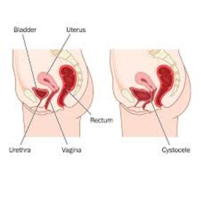 Vaginal Prolapse