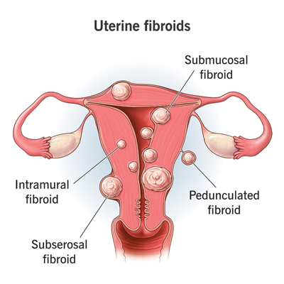 Fibroids