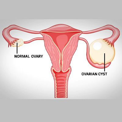 Ovarian Cyst