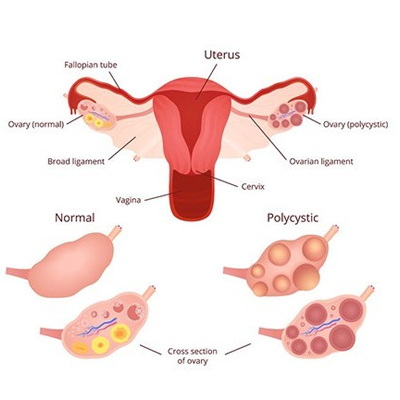 Polycystic Ovarian Disease (PCOS/ PCOD)